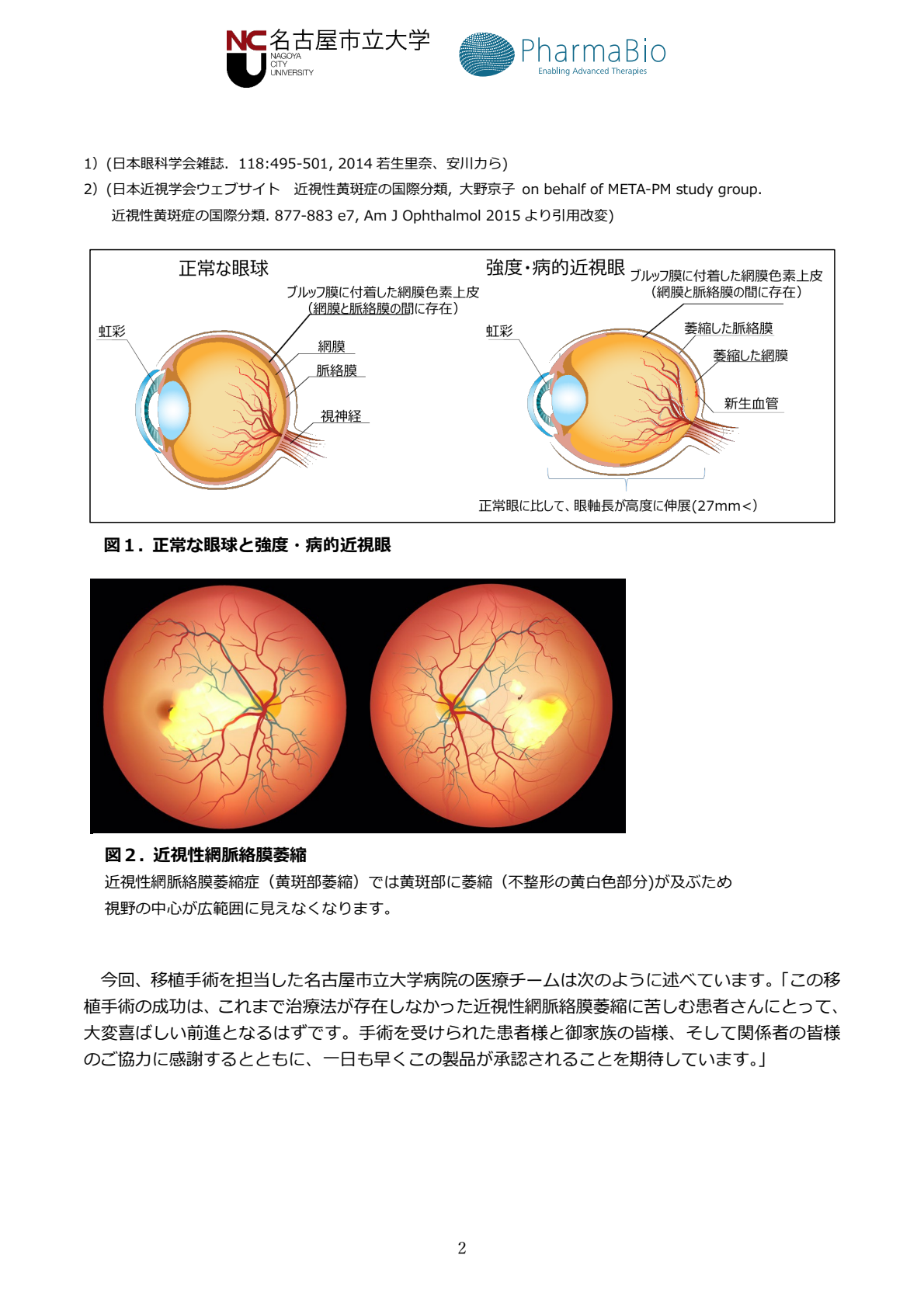 近視性網脈絡膜萎縮症におけるヒト(同種)皮下脂肪組織由来 間葉系幹細胞シート(PAL222)移植の第Ⅰ/Ⅱa相臨床試験(治験) (試験名